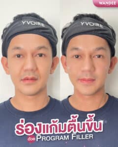 รีวิวฟิลเลอร์ร่องแก้ม