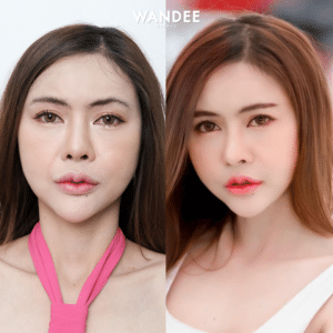 รีวิวฟิลเลอร์ร่องแก้ม