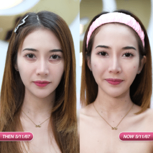 ฟิลเลอร์ใต้ตา