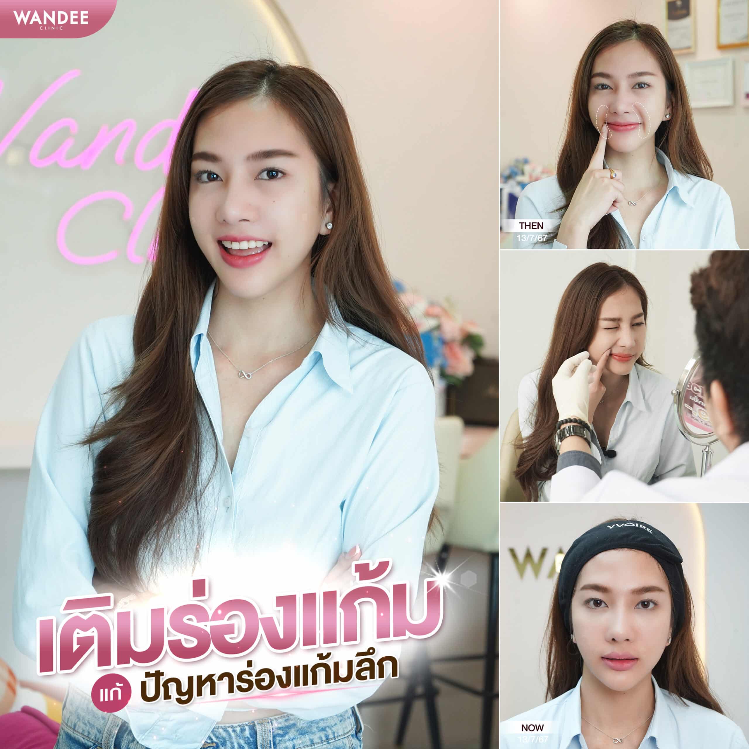 ฟิลเลอร์ร่องแก้ม