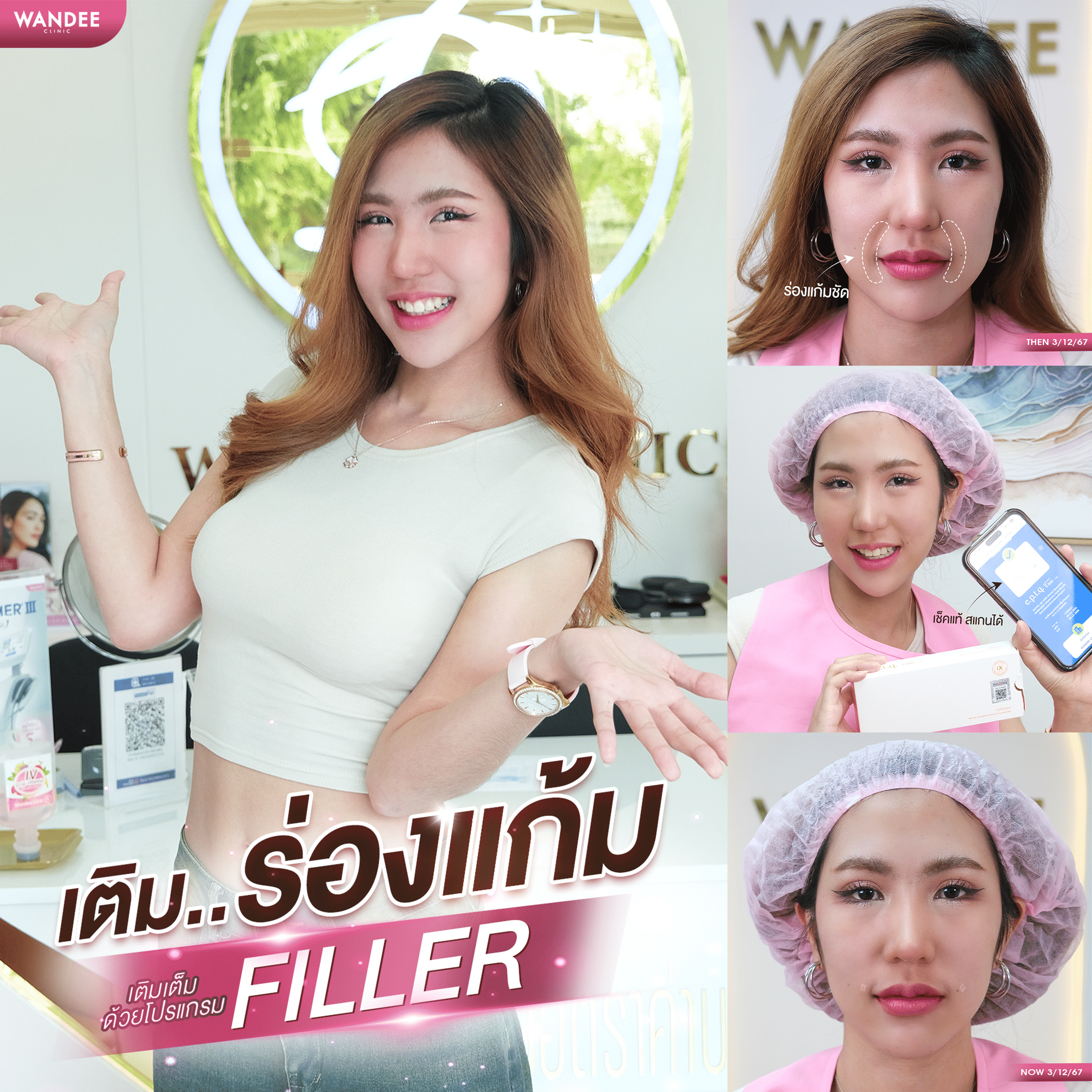 ฟิลเลอร์ร่องแก้ม