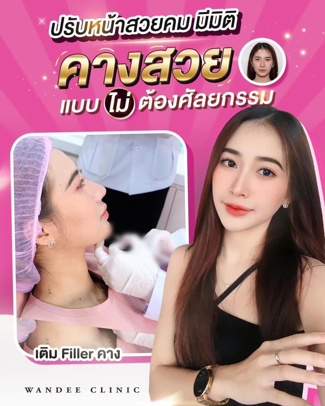 ฟิลเลอร์คาง