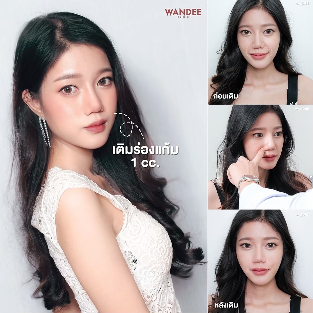 Filler ร่องแก้ม