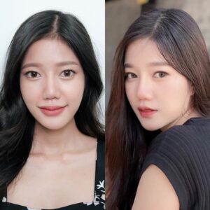 รีวิวฟิลเลอร์ร่องแก้ม