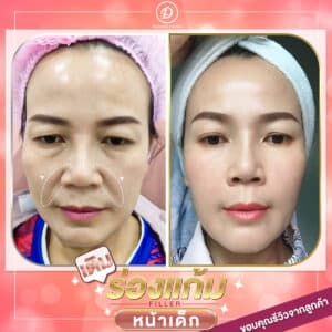 รีวิวฟิลเลอร์ร่องแก้ม