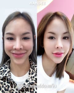 รีวิวฟิลเลอร์ร่องแก้ม