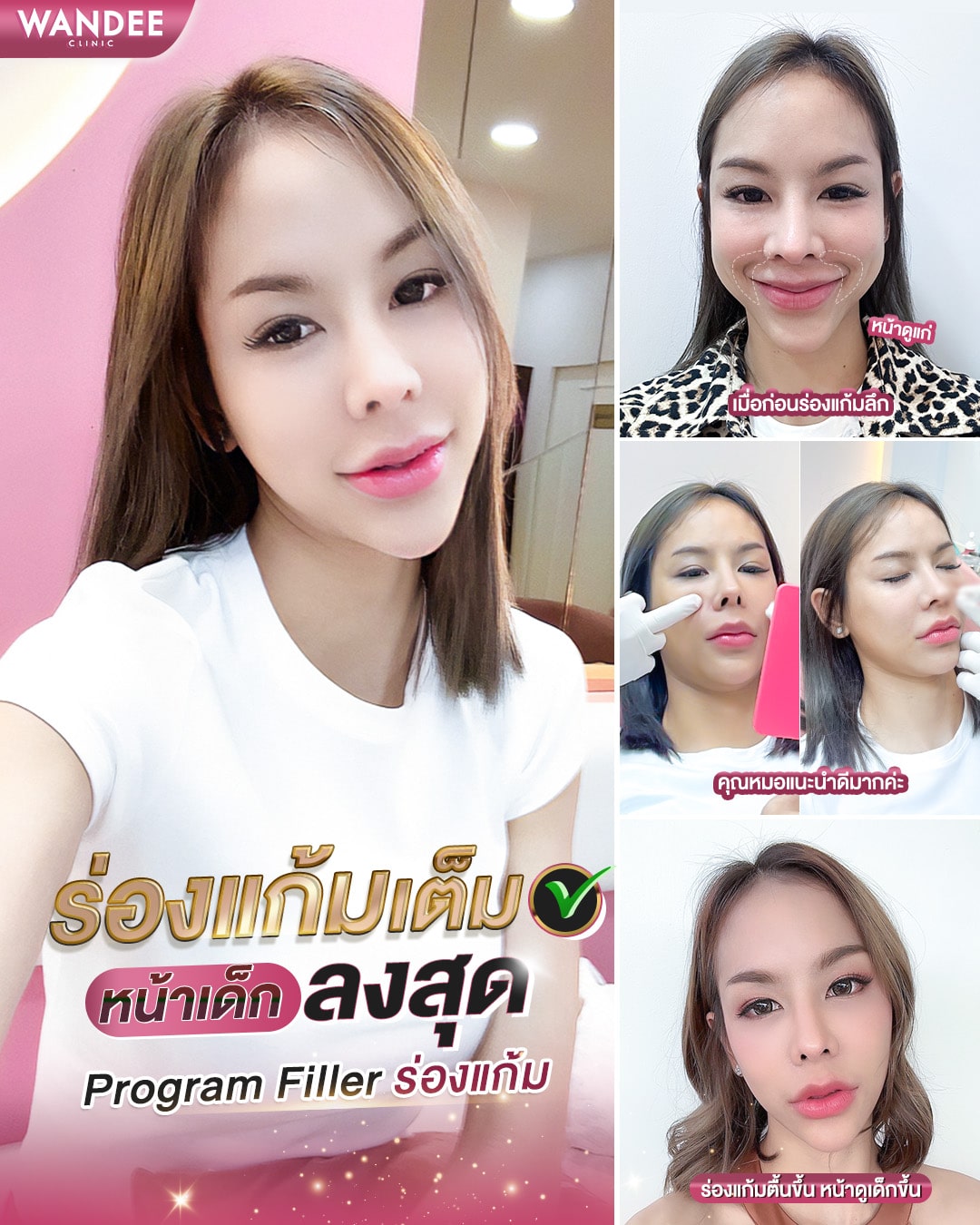 ฟิลเลอร์ร่องแก้ม