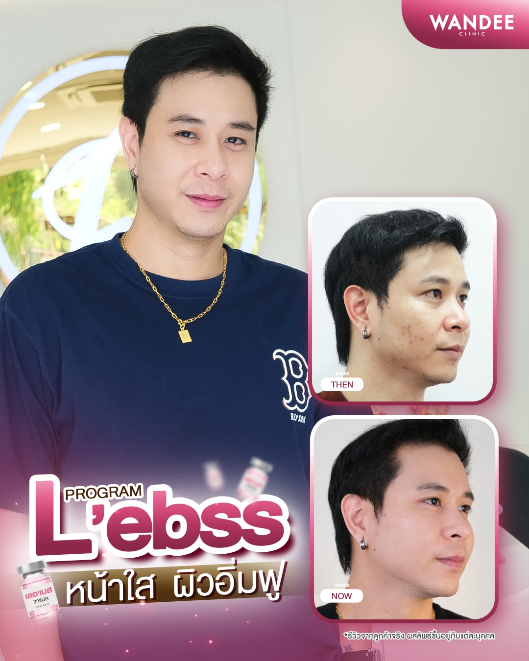 รีวิว Facial Whitening Program